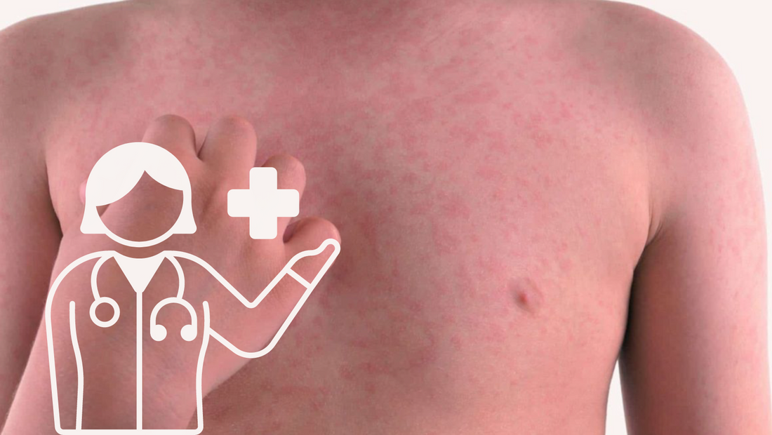 Prevenire e Curare l'Orticaria nei Bambini: Consigli Pratici per Genitori Attenti